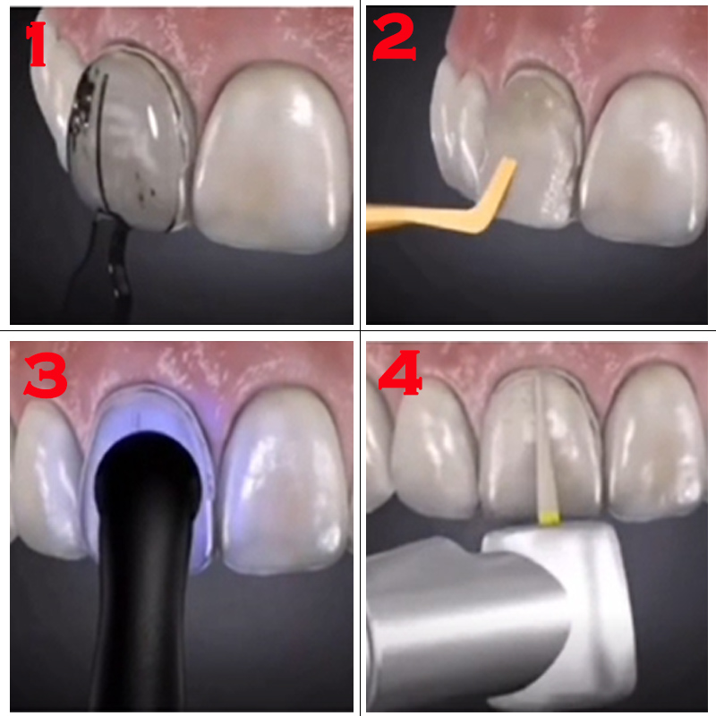 Autoclavable Dental Veneer Mou - Teeth Whitening Moulds recension och pris
