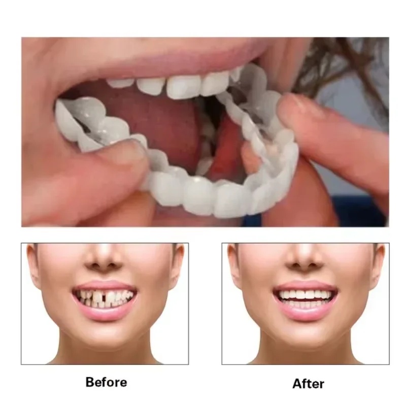 Snap-on Veneer Teeth Kit Adjus - Teeth Whitening Kit recension och pris